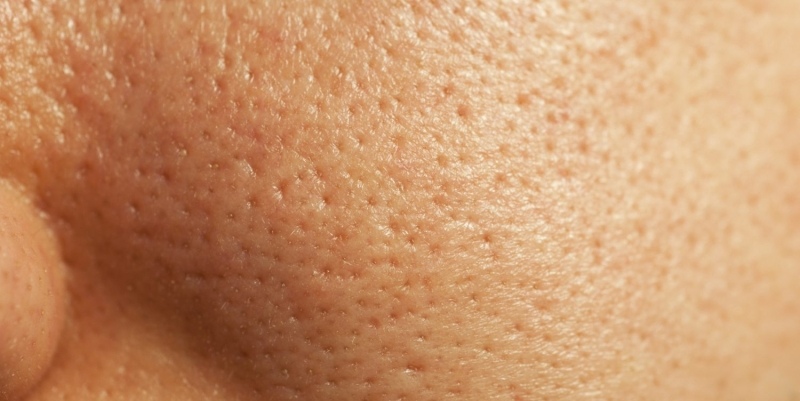 Как уменьшить расширенные поры: 8 эффективных рецептов! Как уменьшить расширенные поры: 8 эффективных рецептов!