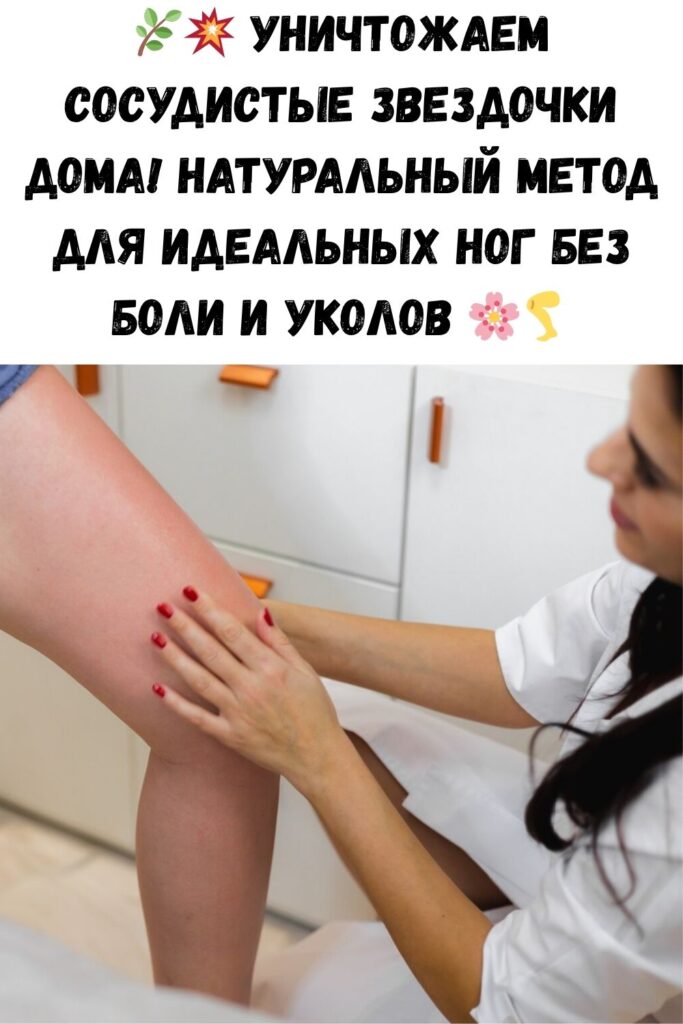 Уничтожаем &laquo;СОСУДИСТЫЕ ЗВЕЗДОЧКИ&raquo; на ногах без операций и лекарств!