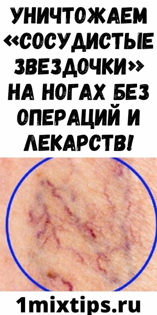 Уничтожаем &laquo;СОСУДИСТЫЕ ЗВЕЗДОЧКИ&raquo; на ногах без операций и лекарств!